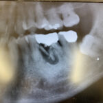 院長森山ののレントゲン写真