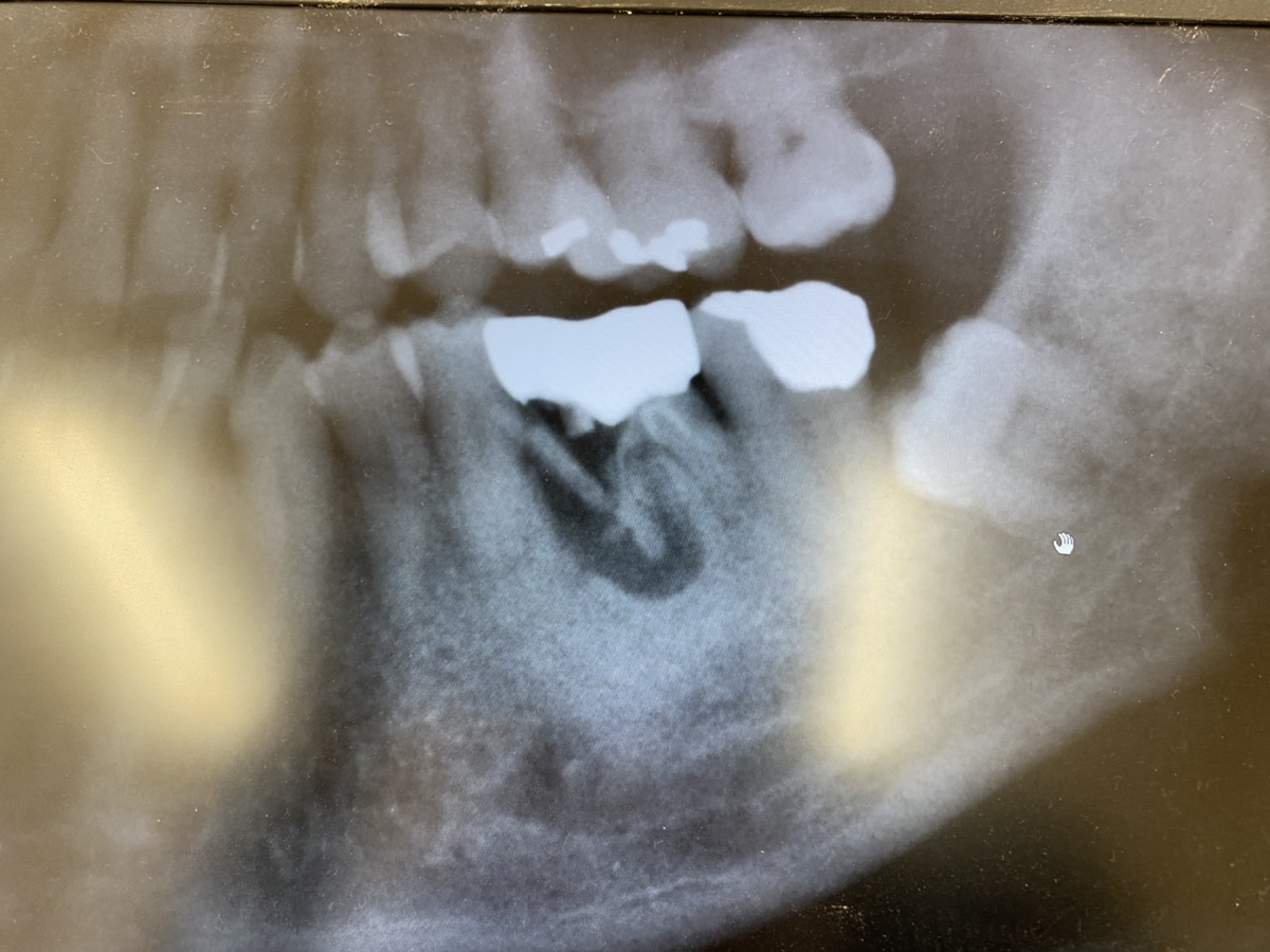 院長森山ののレントゲン写真